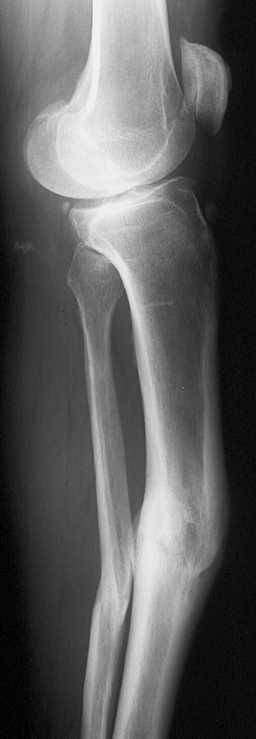 Tibial Malunion And Medial Knee Oa