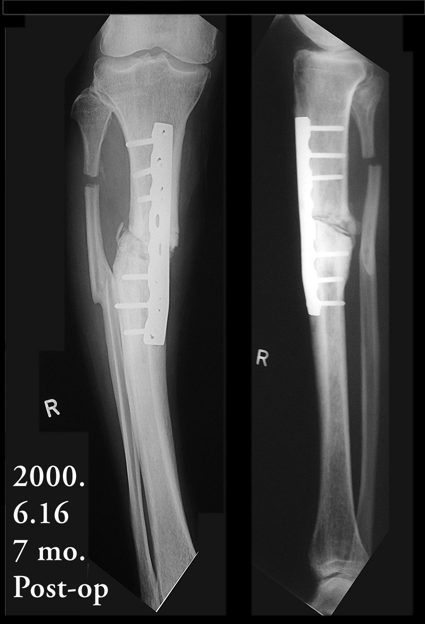 Tibial Varus Malunion