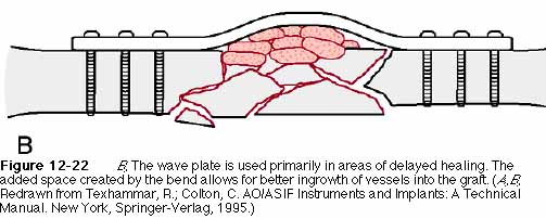 Wave plate osteosynthesis 07 picture