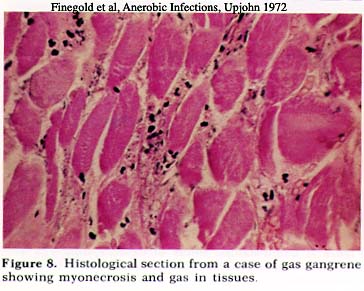 Gas Gangrene